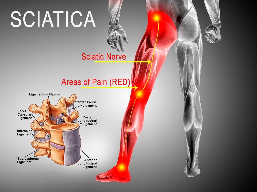 Best Ways To Treat Sciatica Pain Colorado Pain Care Best Ways To Treat Sciatica Pain Colorado Pain Care