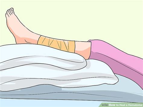 How To Heal A Hematoma 10 Steps With Pictures Wikihow How To Heal A Hematoma 10 Steps With Pictures Wikihow