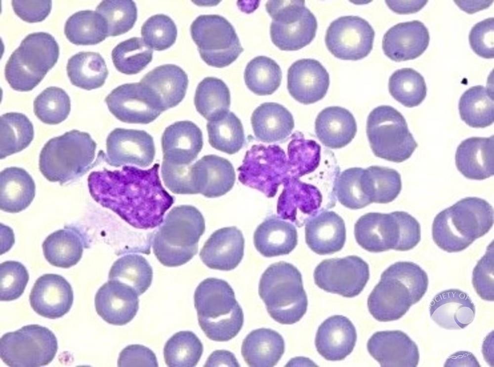 Why Large Granular Lymphocytes Matter In Immunity And Disease