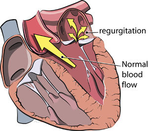 Leaking Heart Valve: Causes and Treatments