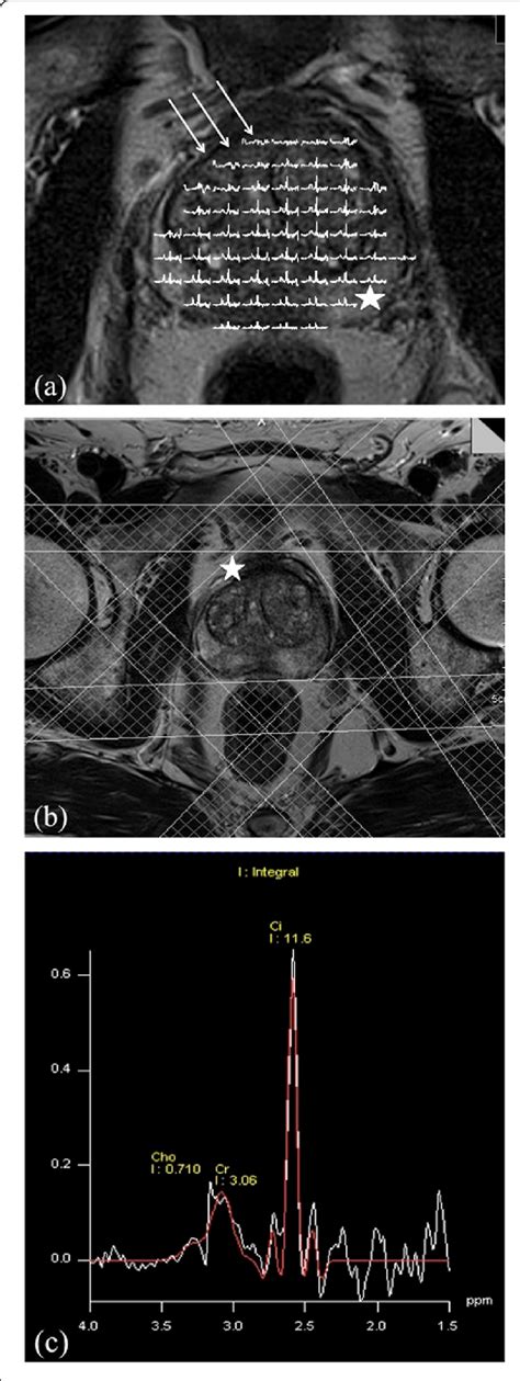 Prostate Spectroscopy With Conventional Planning Of Saturation Pulses Download Scientific Diagram Prostate Spectroscopy With Conventional Planning Of Saturation Pulses Download Scientific Diagram