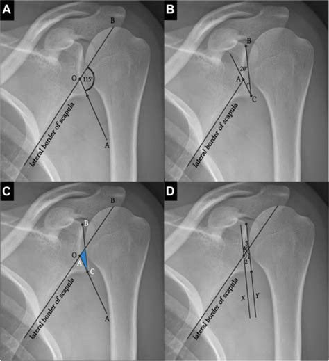 The Base Plate Orientation Angle A Plain Radiographic Technique For