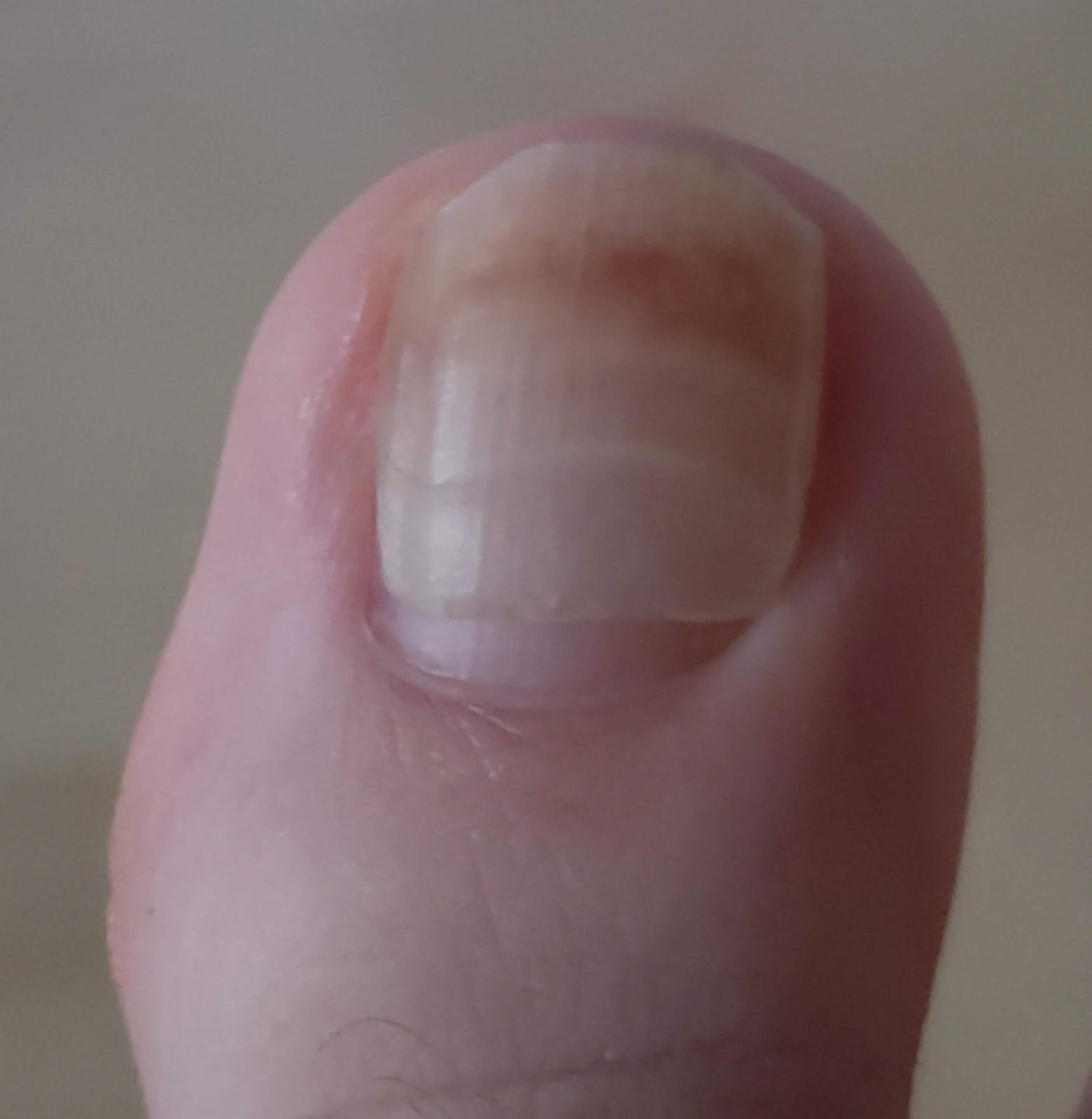 Shocking Fact: Toenail Growing Under Toenail May Signal Infection